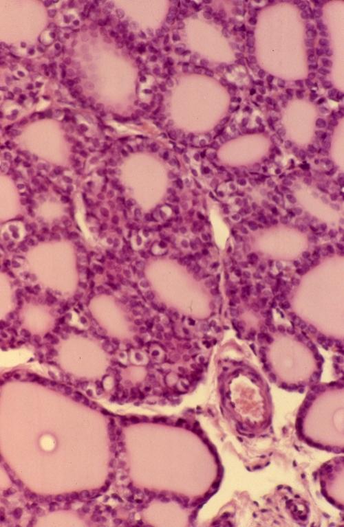 Endocrinal - parathyroid and thyroid 2