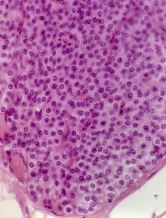 Endocrinal - parathyroid and thyroid 3